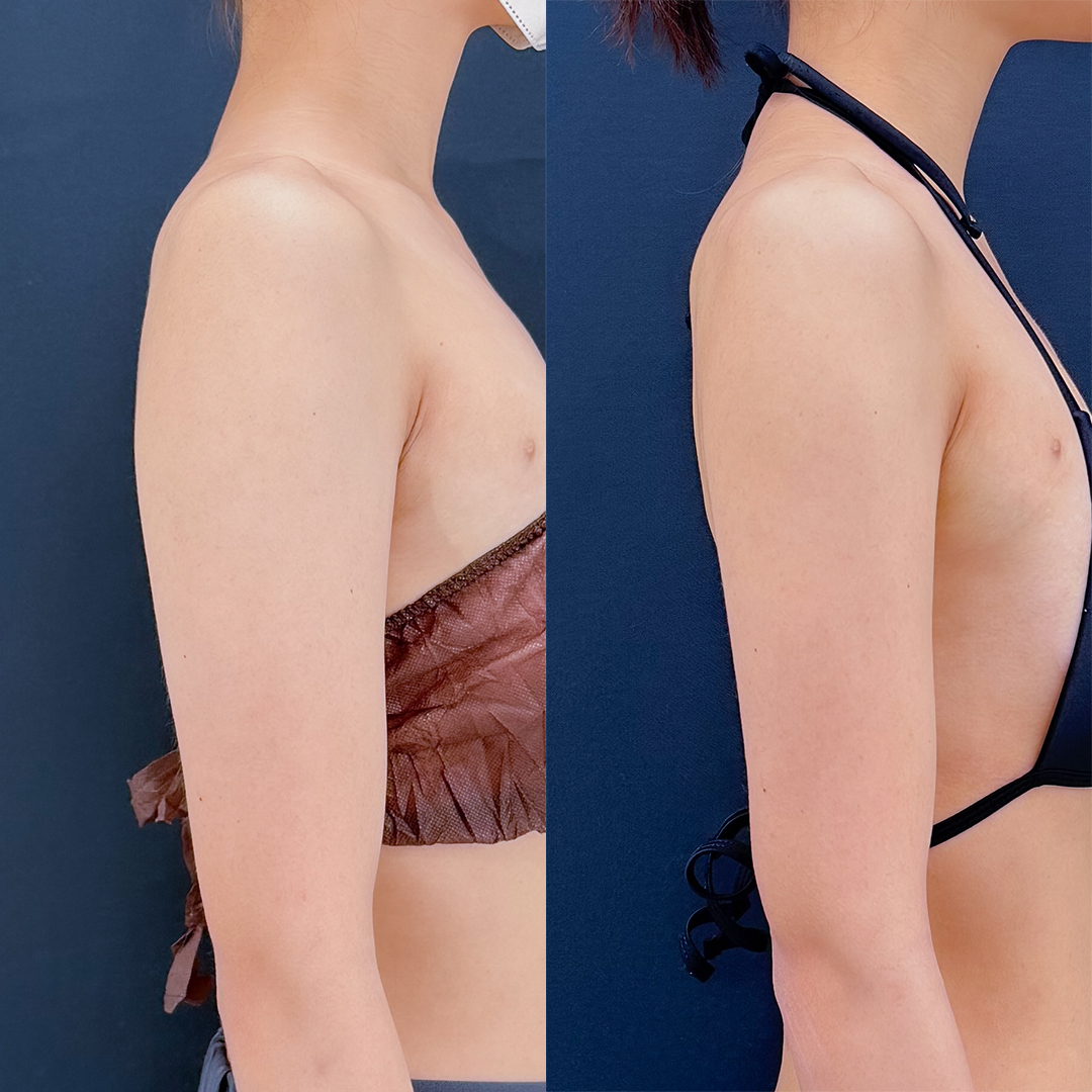 https://purelys-tokyo-clinic.com/wp/wp-content/uploads/2026/04/arm-Liposuction_Case-No.593.jpg
