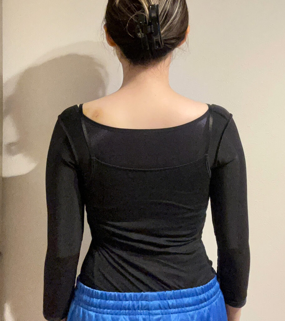 二の腕の脂肪吸引