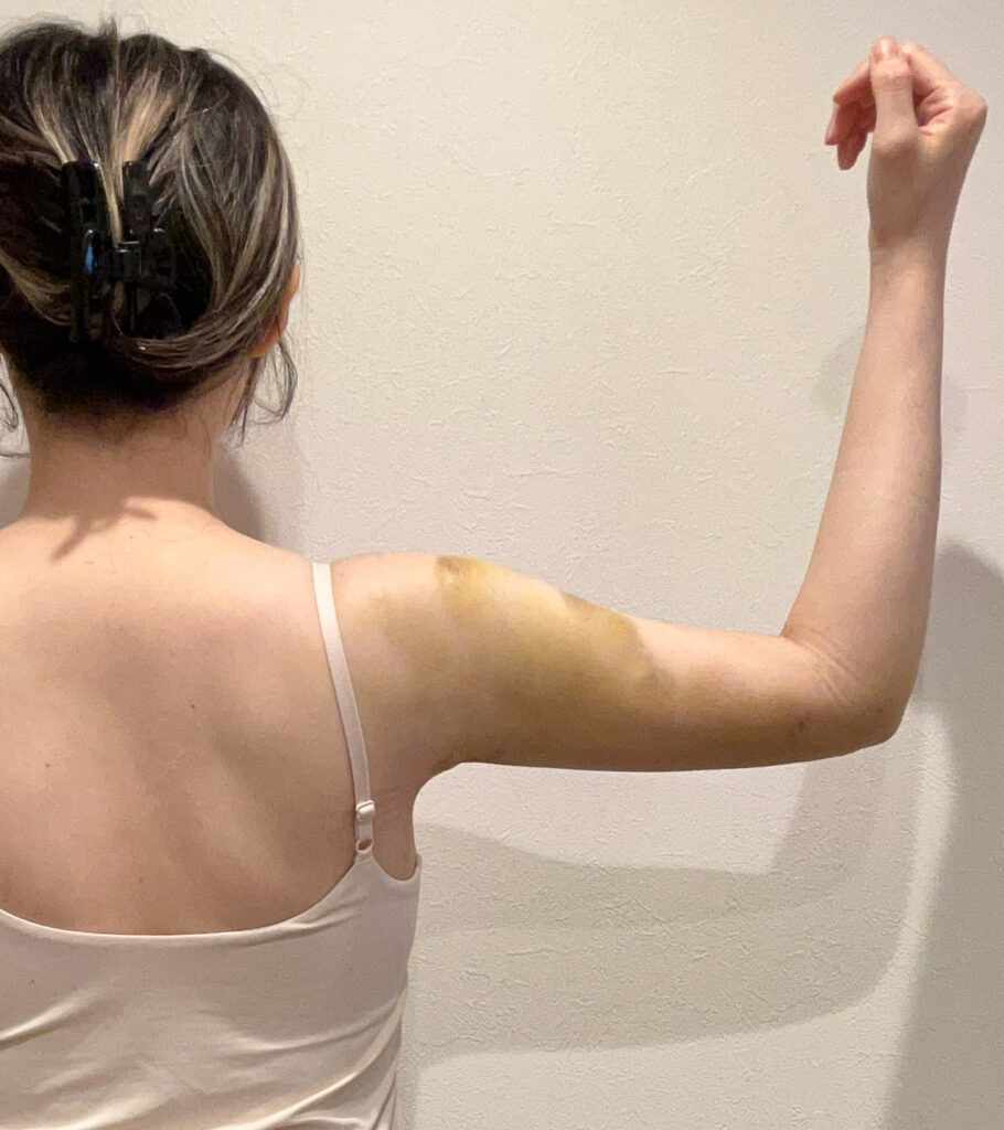 二の腕の脂肪吸引