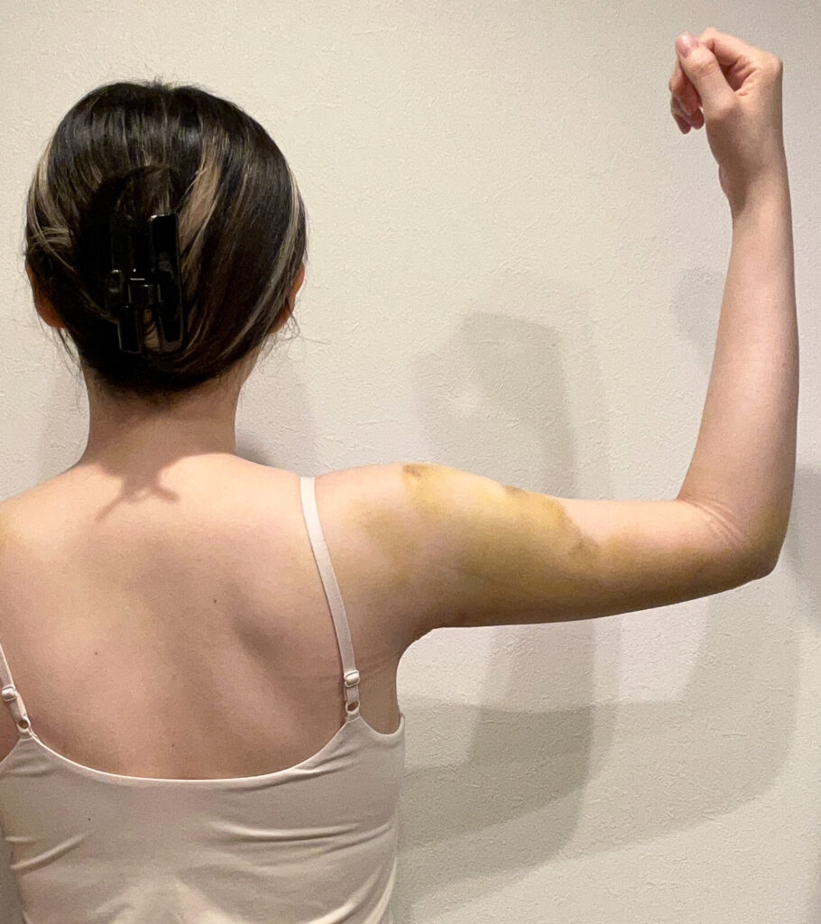 二の腕の脂肪吸引