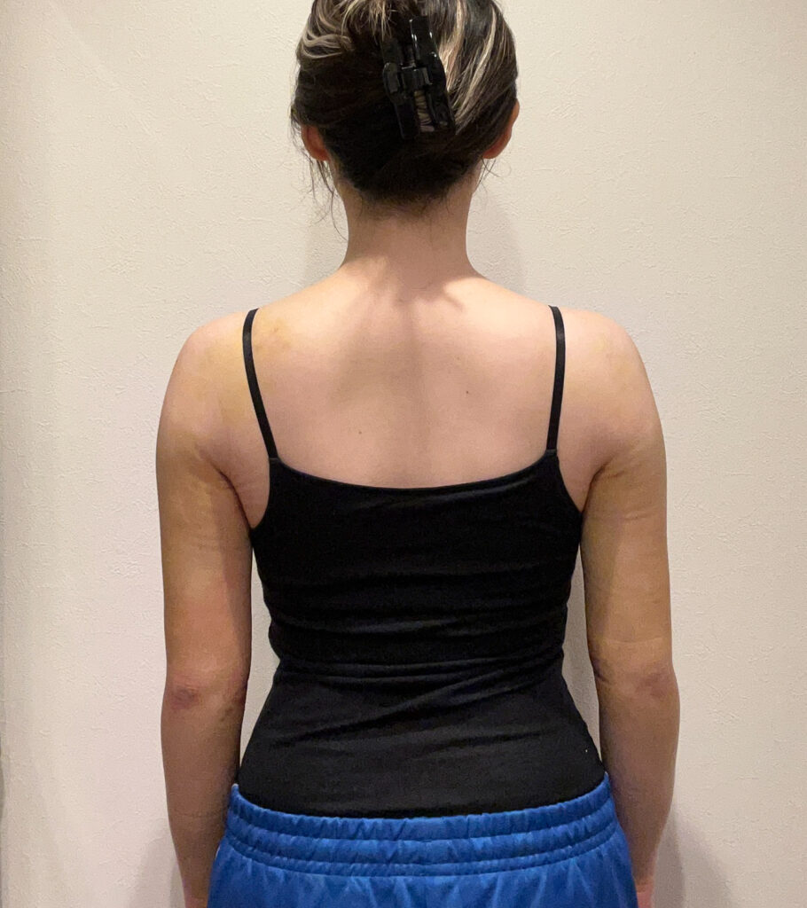 二の腕の脂肪吸引