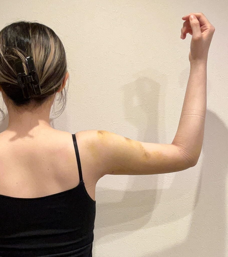 二の腕の脂肪吸引