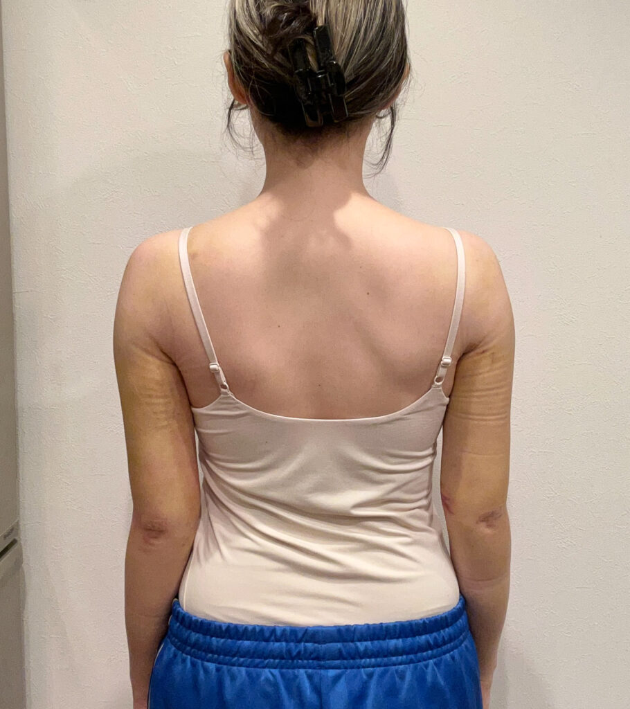 二の腕の脂肪吸引