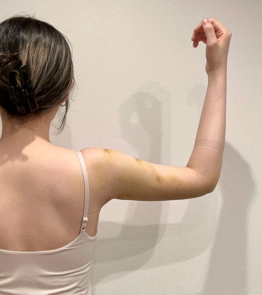 二の腕の脂肪吸引