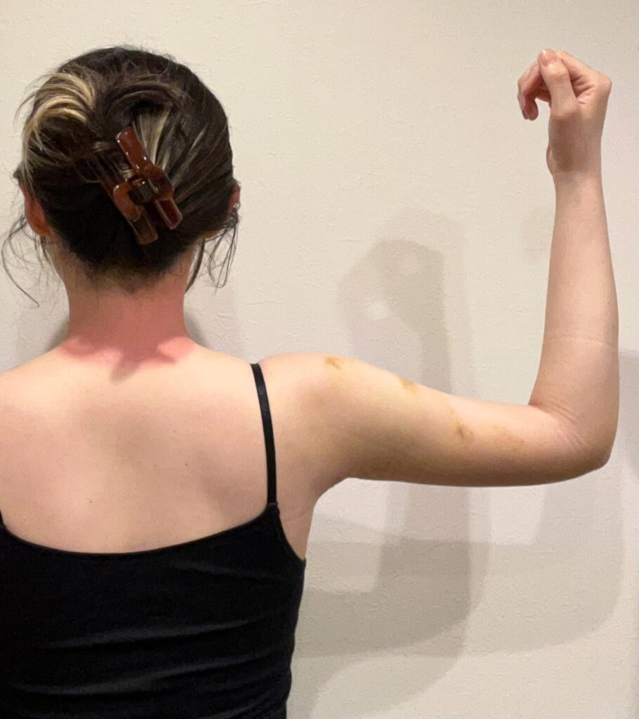 二の腕の脂肪吸引