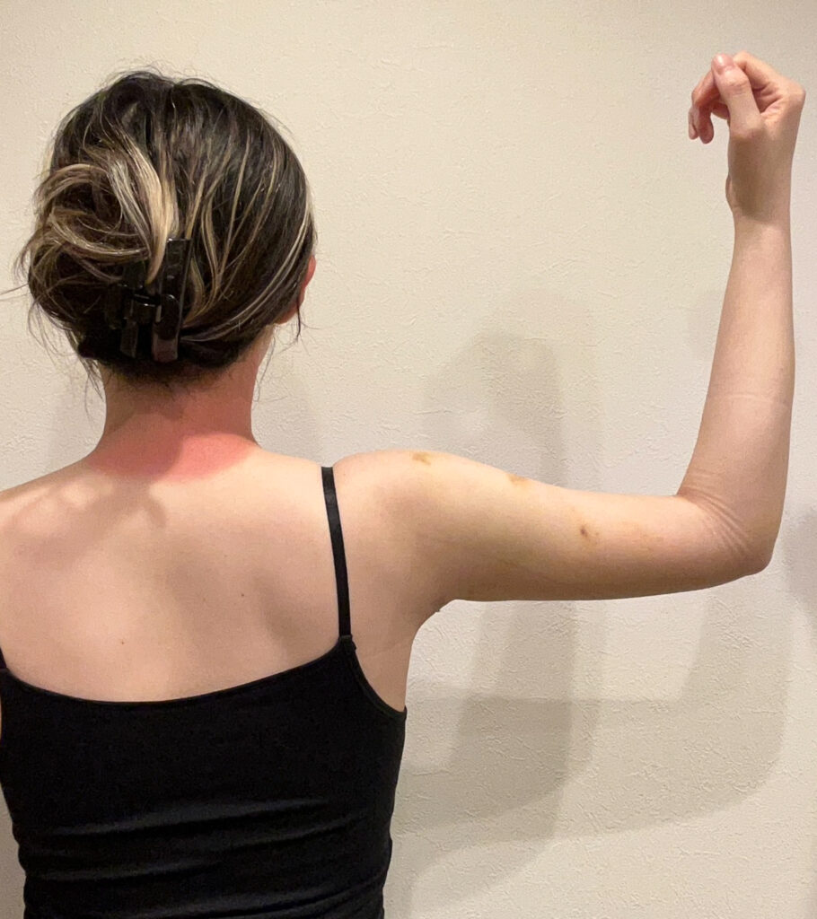 二の腕の脂肪吸引