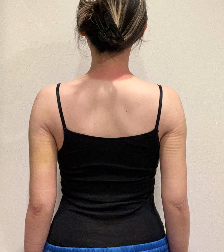 二の腕の脂肪吸引