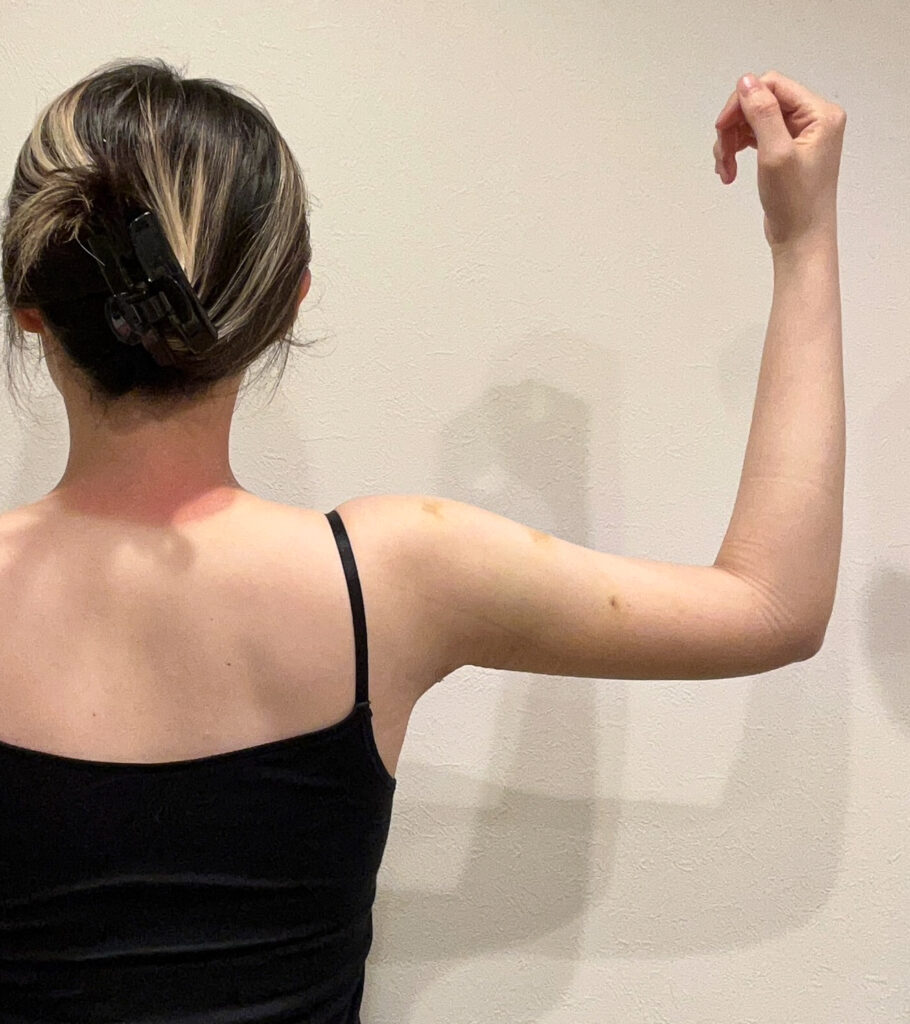 二の腕の脂肪吸引