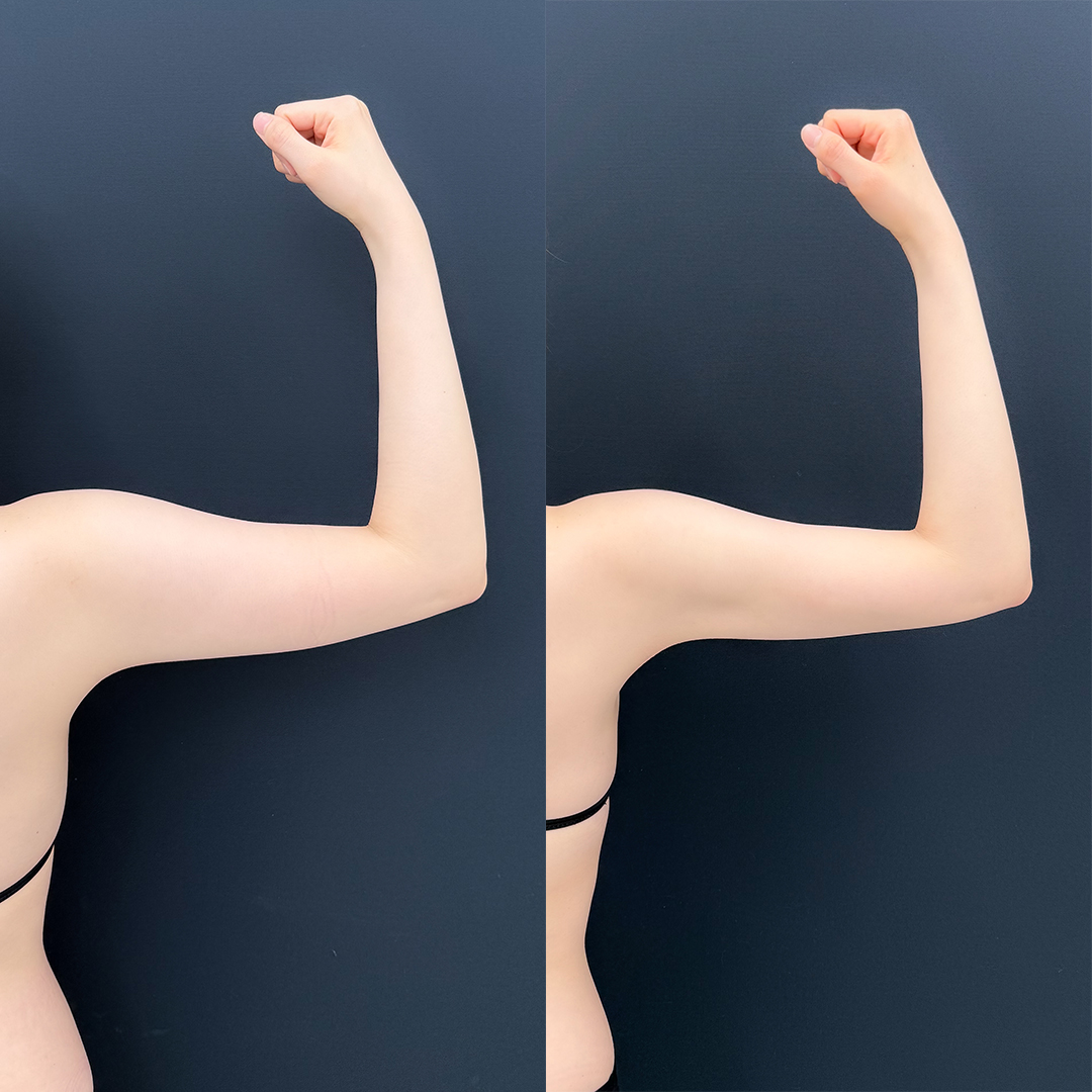 https://purelys-tokyo-clinic.com/wp/wp-content/uploads/2026/04/arm-Liposuction_Case-No.627.jpg