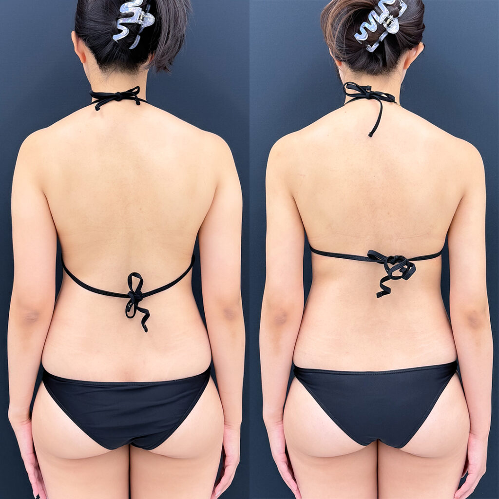 二の腕の脂肪吸引