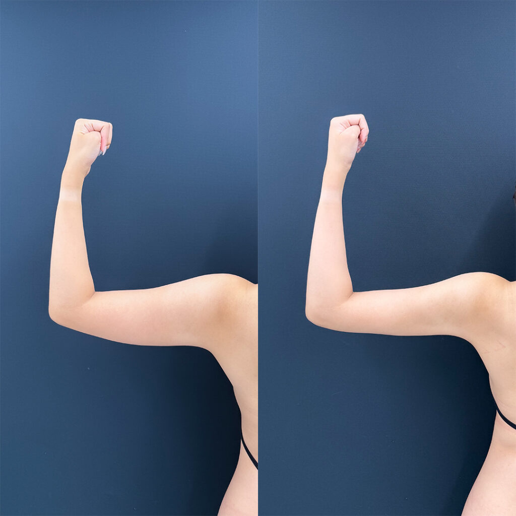 二の腕の脂肪吸引