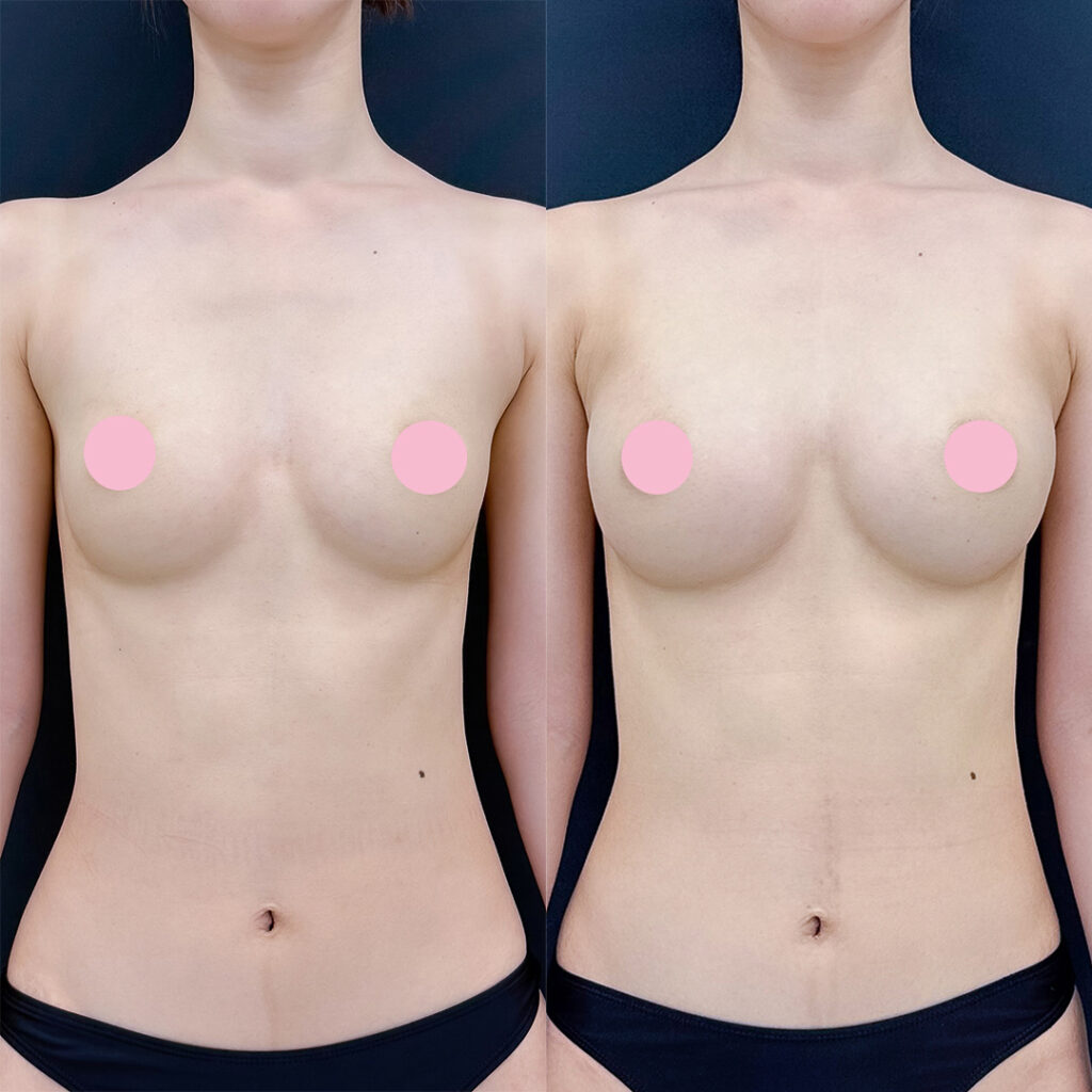 脂肪豊胸