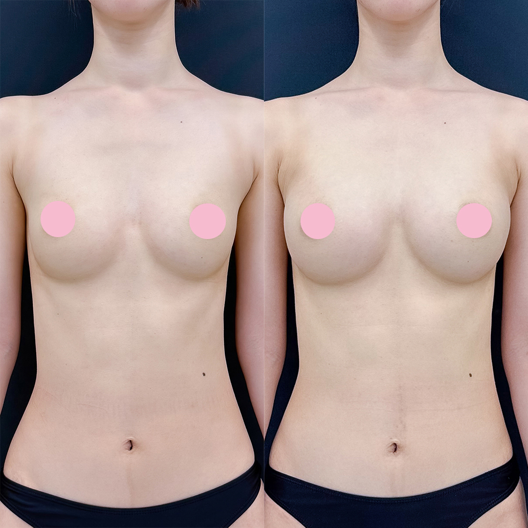 脂肪豊胸