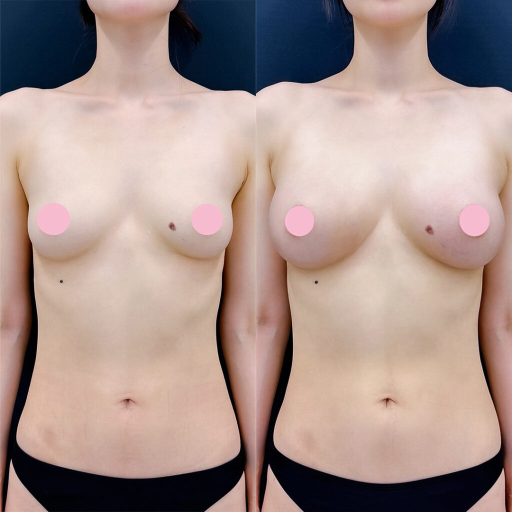 脂肪豊胸