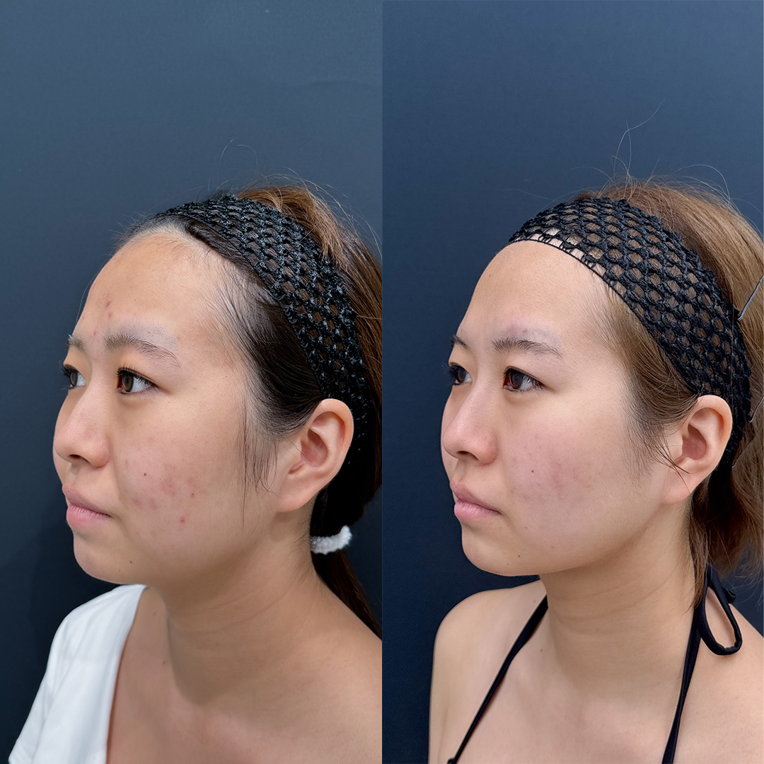 https://purelys-tokyo-clinic.com/wp/wp-content/uploads/2026/04/face-Liposuction_Case-No.506.jpg