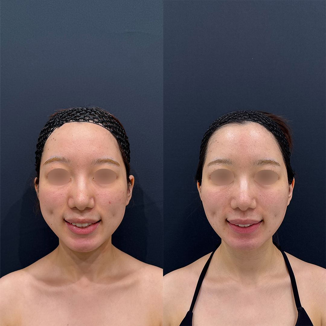 https://purelys-tokyo-clinic.com/wp/wp-content/uploads/2026/04/face-Liposuction_Case-No.519.jpg