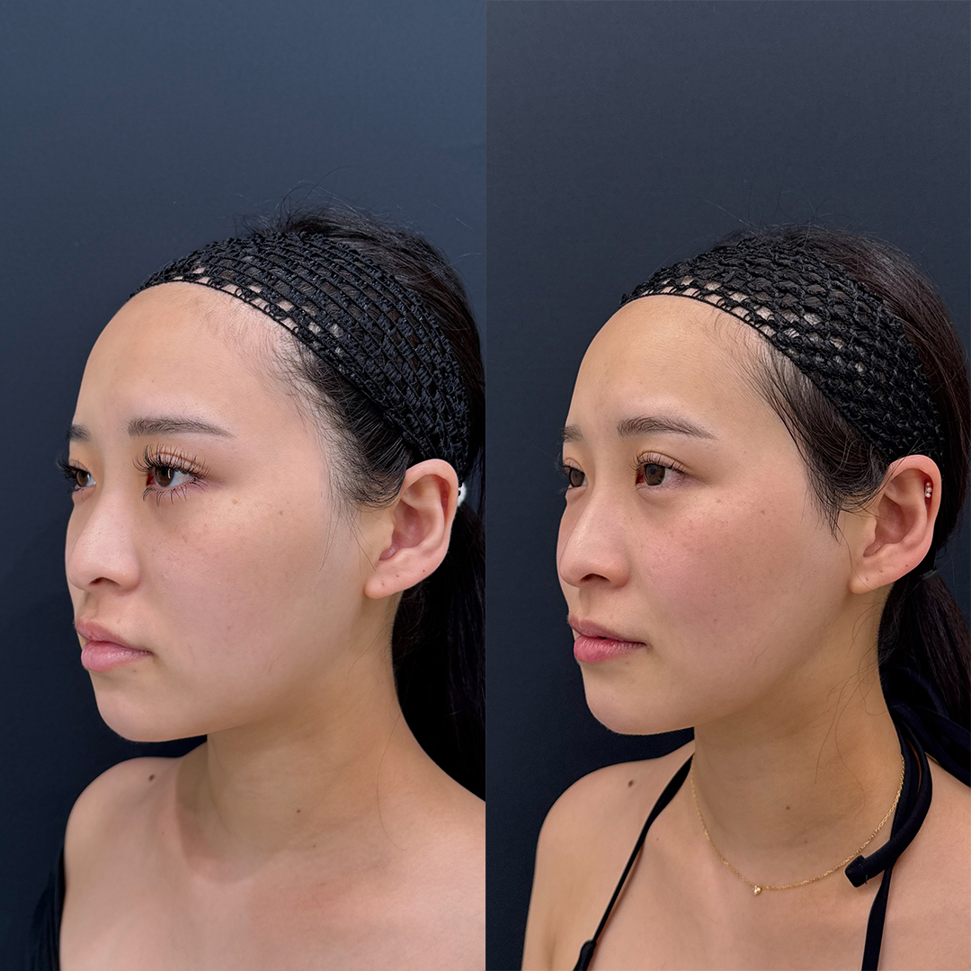 https://purelys-tokyo-clinic.com/wp/wp-content/uploads/2026/04/face-Liposuction_Case-No.537.jpg