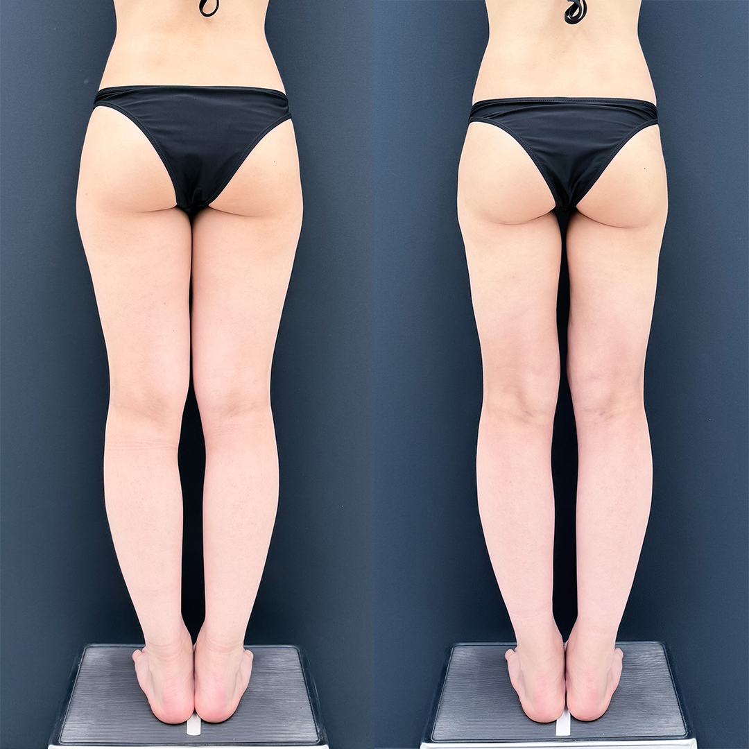 https://purelys-tokyo-clinic.com/wp/wp-content/uploads/2026/04/leg-Liposuction_Case-No.774.jpg
