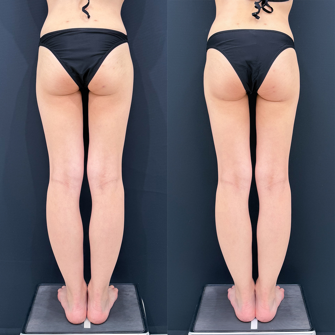 https://purelys-tokyo-clinic.com/wp/wp-content/uploads/2026/04/leg-Liposuction_Case-No.807.jpg