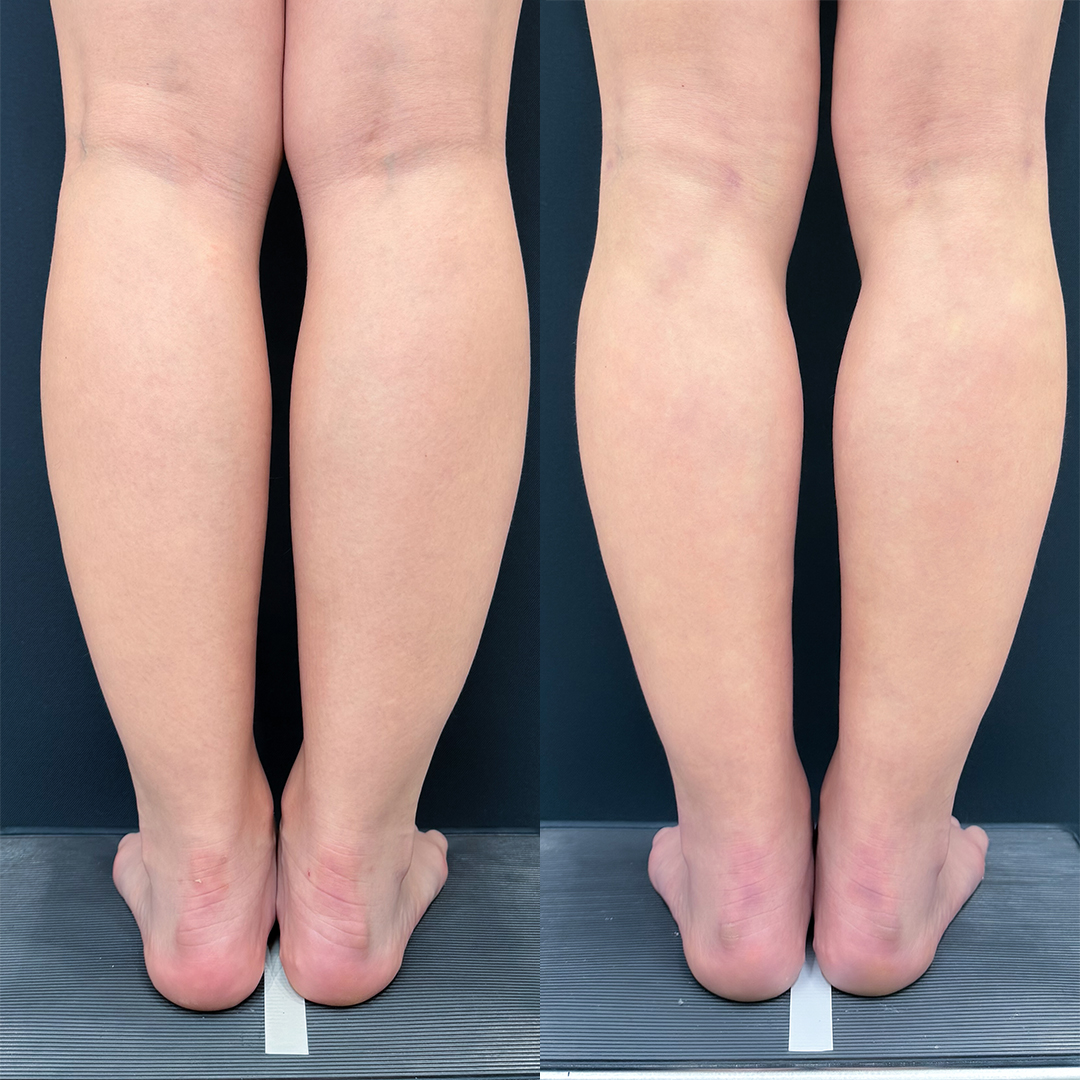 ふくらはぎの脂肪吸引
