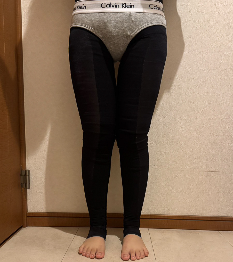 足の脂肪吸引