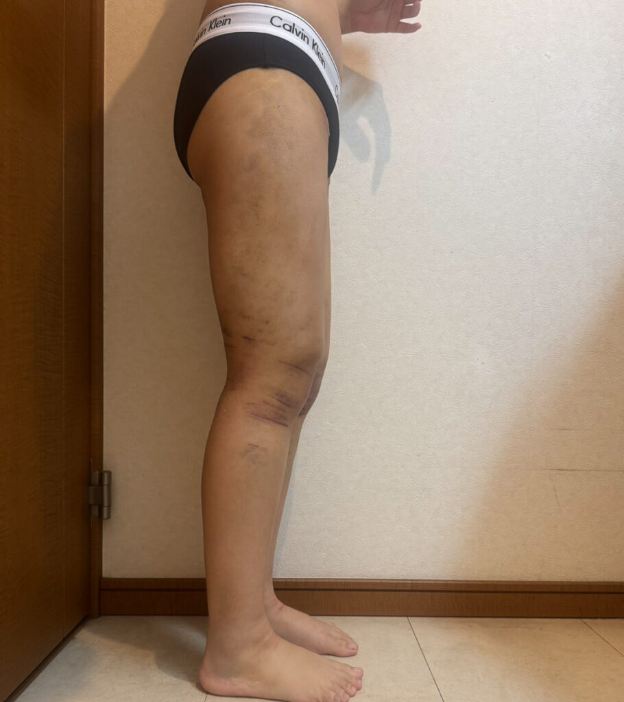 足の脂肪吸引