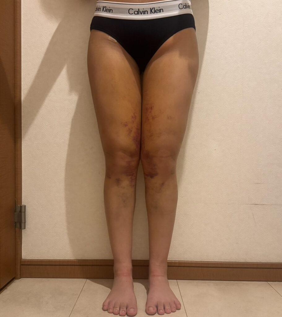 足の脂肪吸引