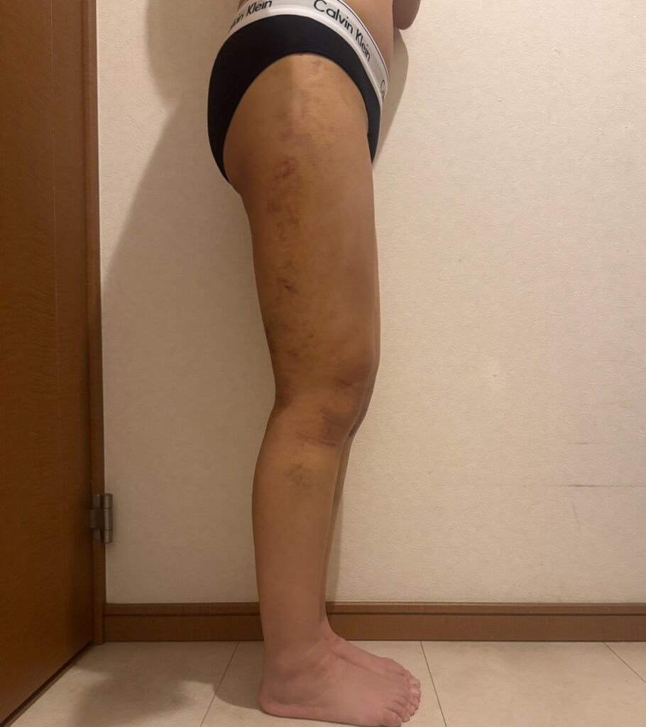 足の脂肪吸引
