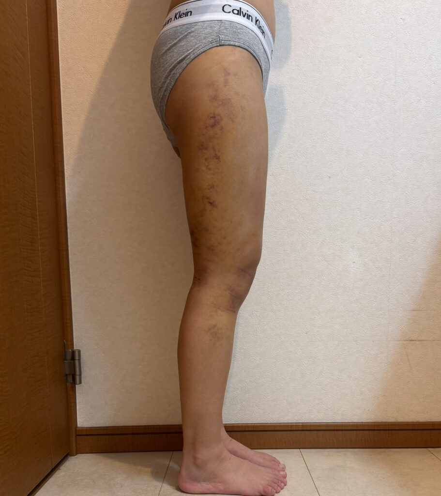 足の脂肪吸引