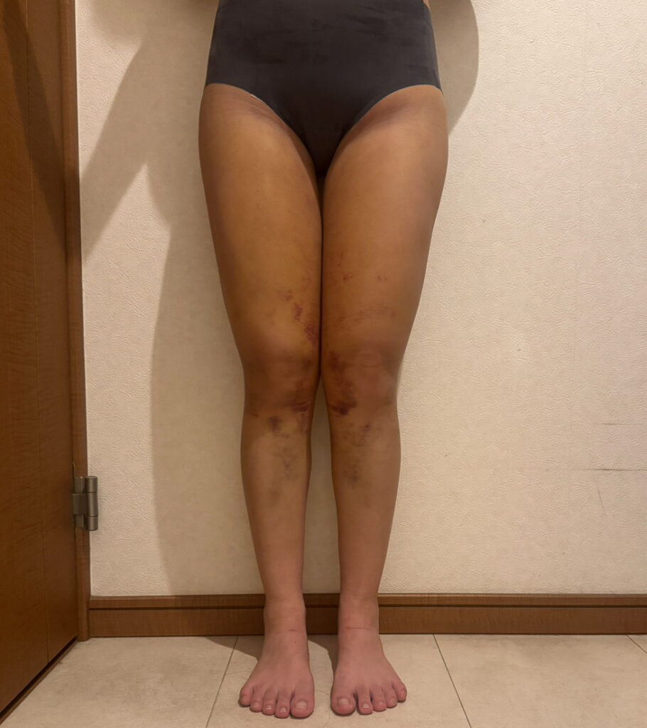 足の脂肪吸引
