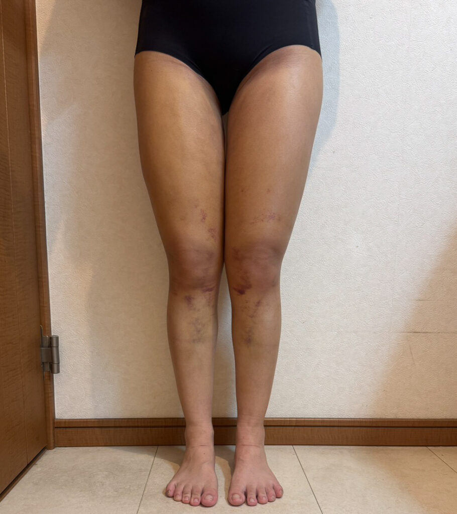 足の脂肪吸引