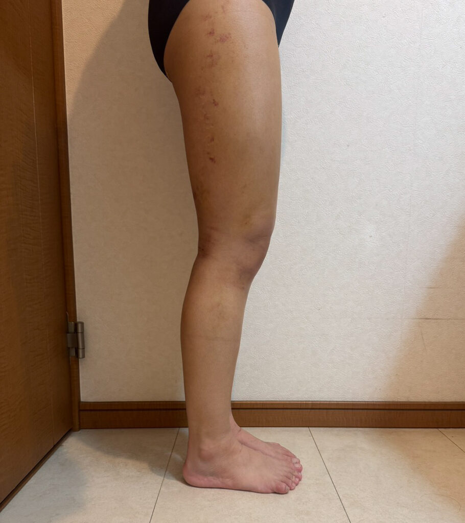 足の脂肪吸引