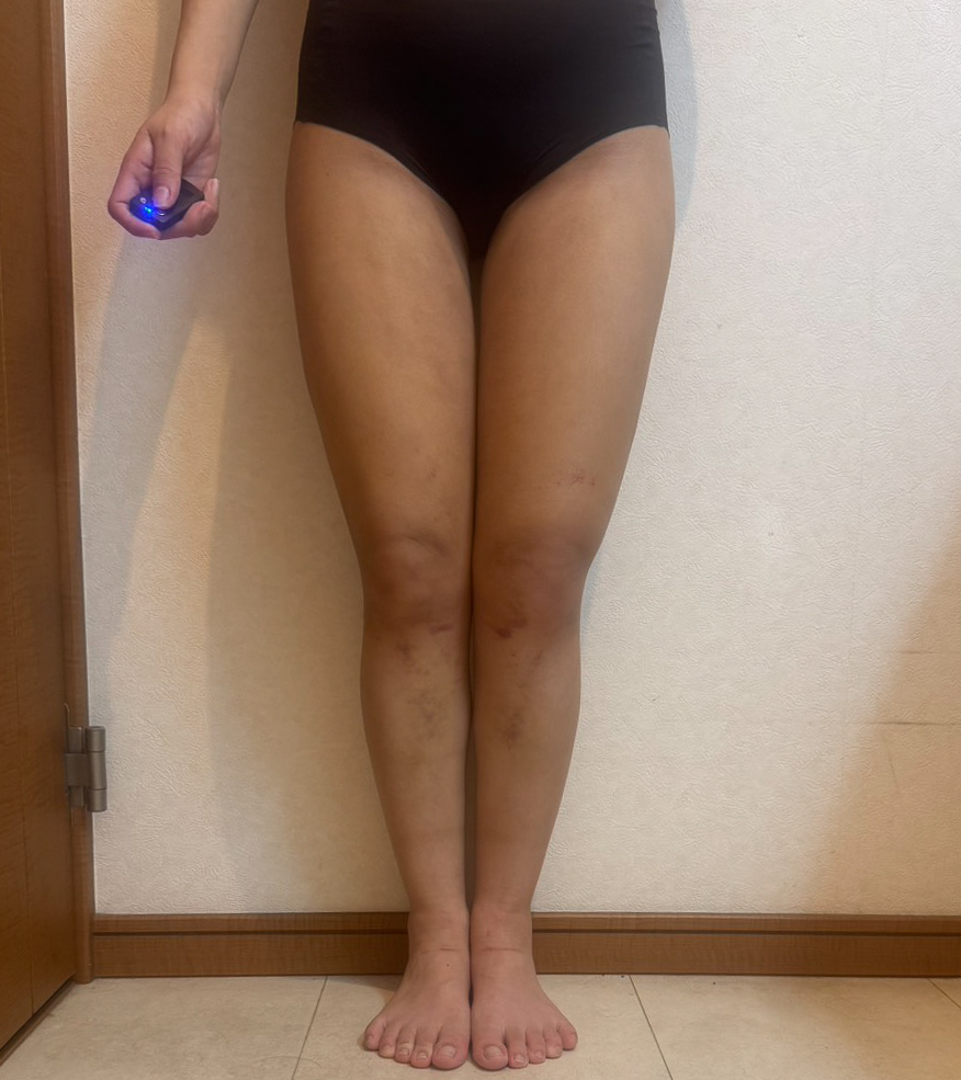 足の脂肪吸引