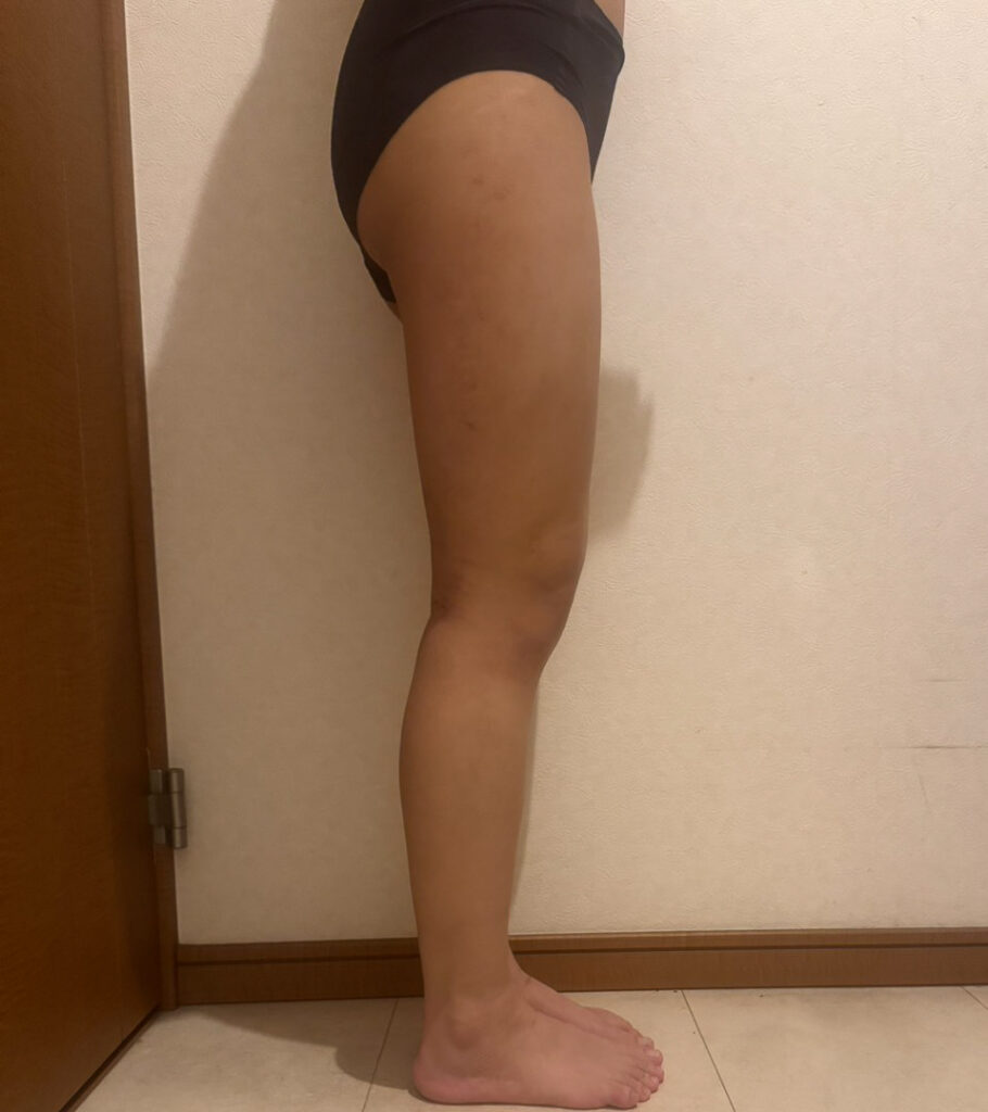 足の脂肪吸引