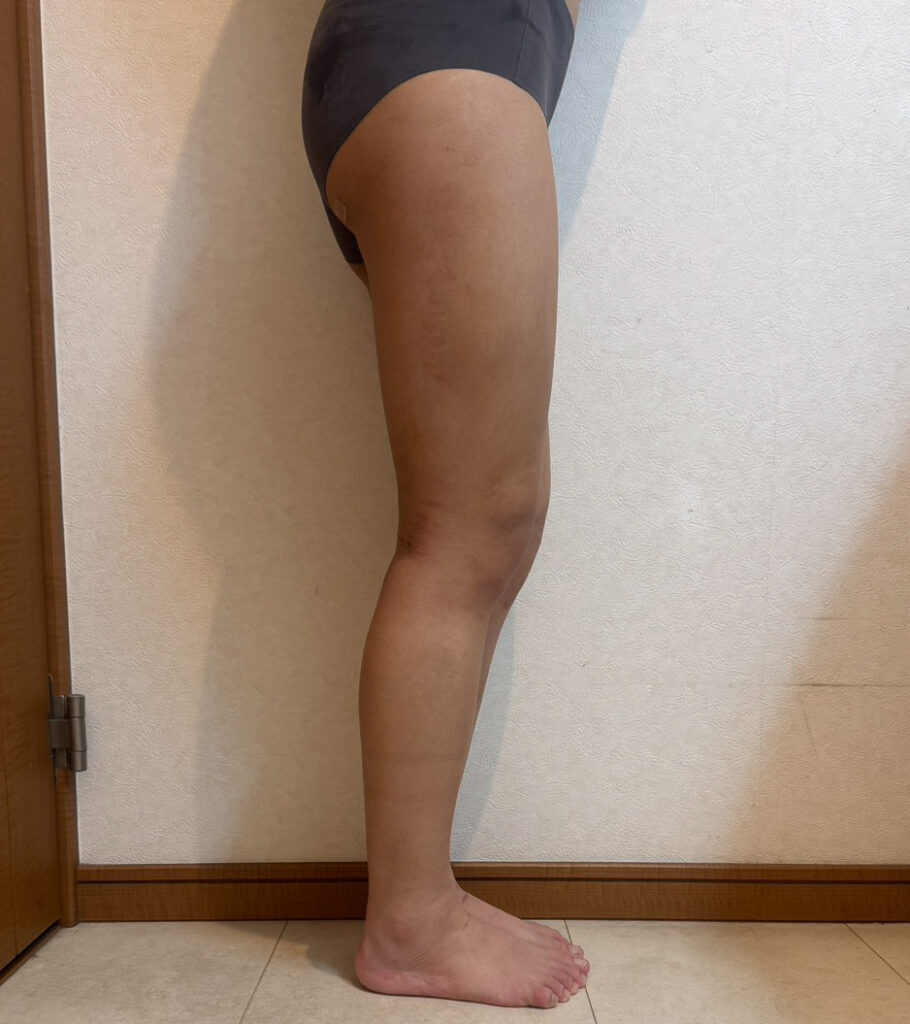 足の脂肪吸引