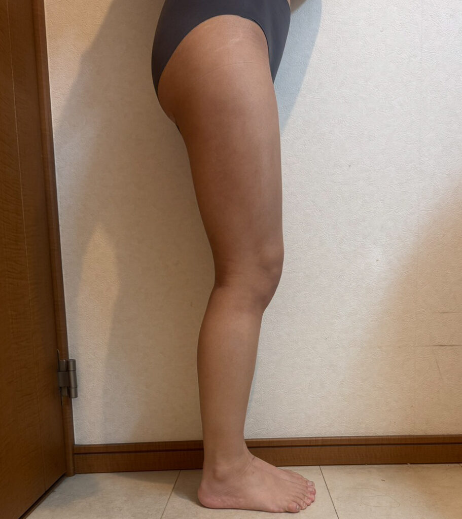 足の脂肪吸引