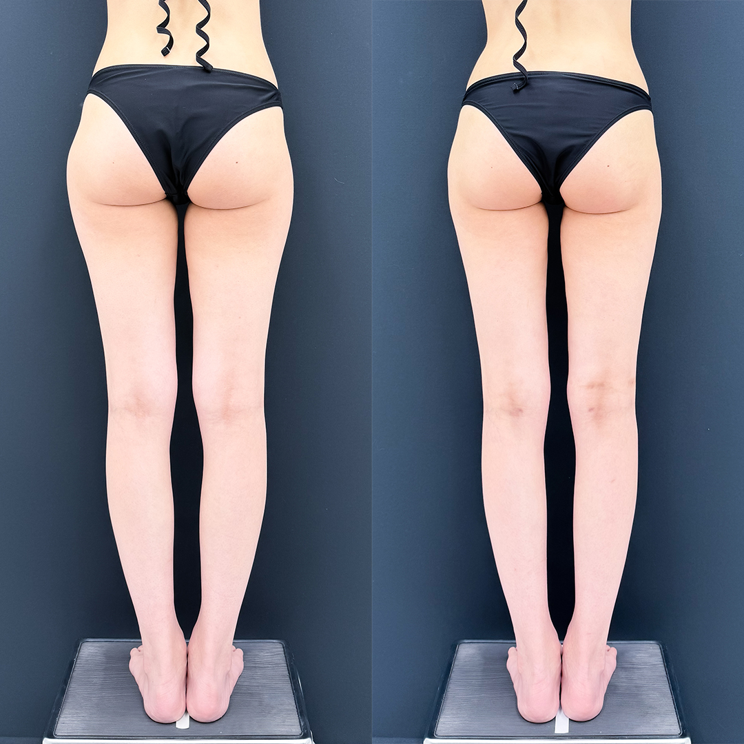https://purelys-tokyo-clinic.com/wp/wp-content/uploads/2026/04/leg-Liposuction_Case-No.840.jpg