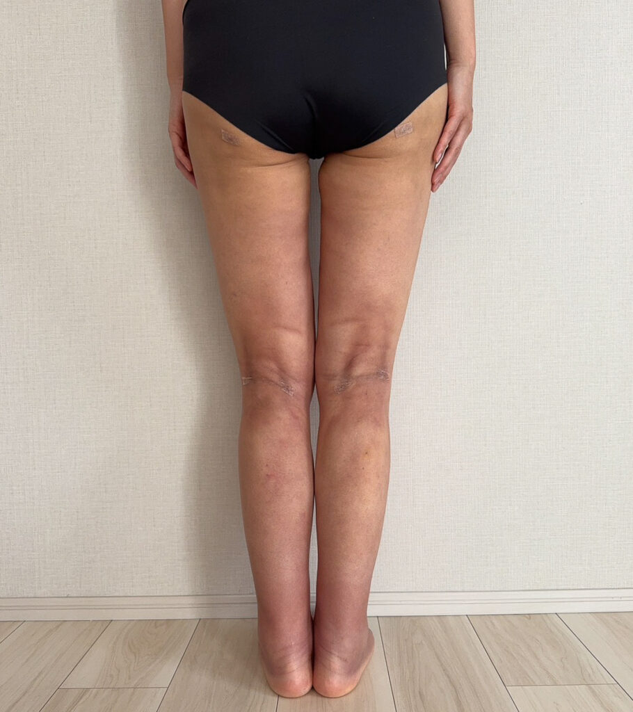 足の脂肪吸引