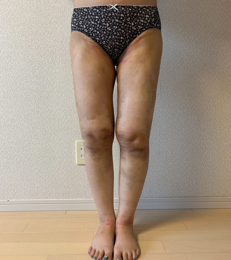 足の脂肪吸引