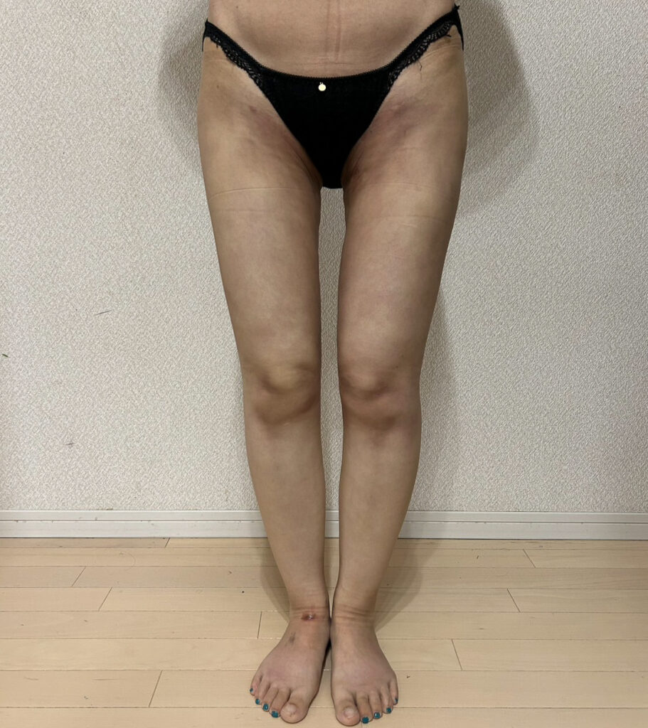 足の脂肪吸引