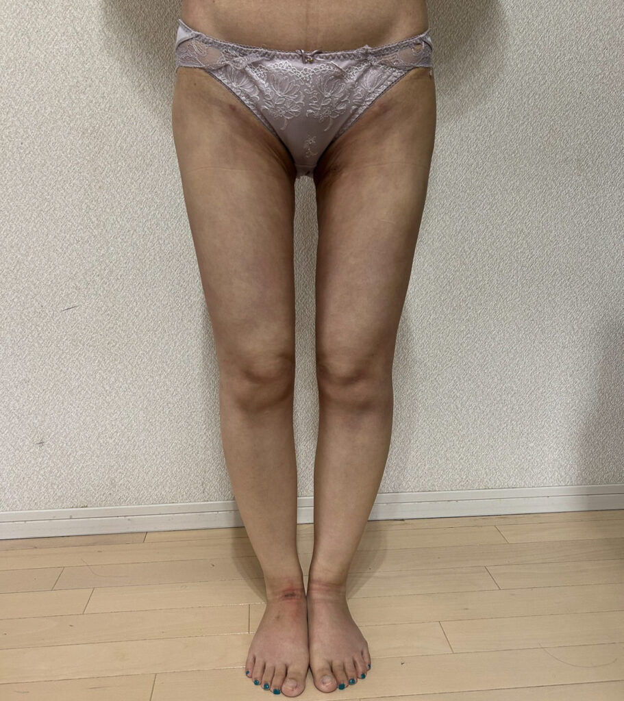 足の脂肪吸引