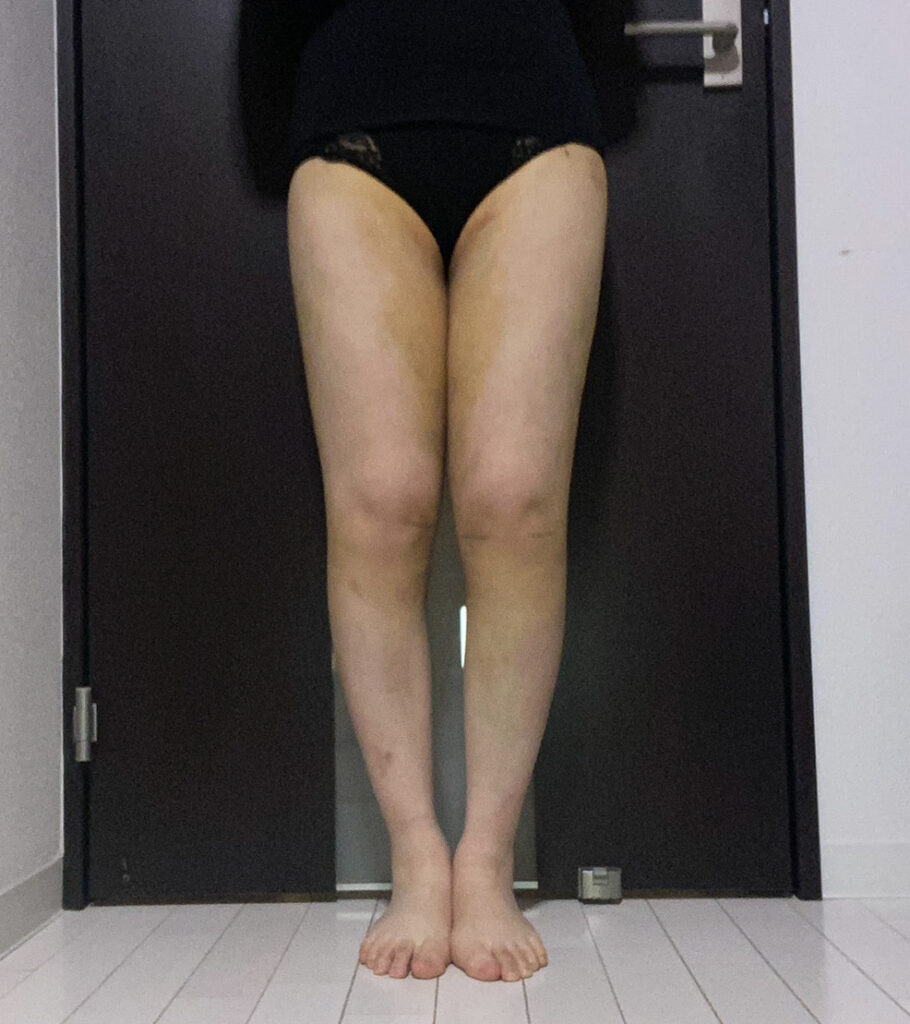 足の脂肪吸引
