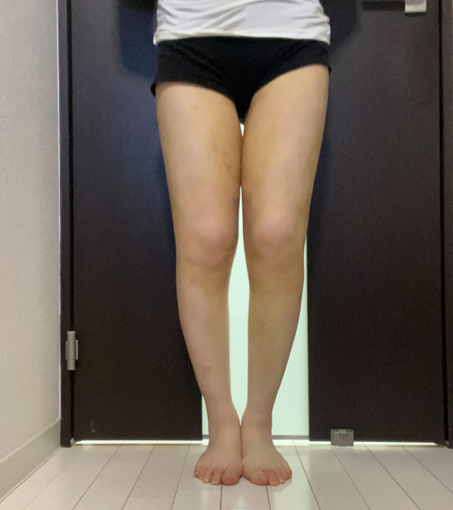 足の脂肪吸引