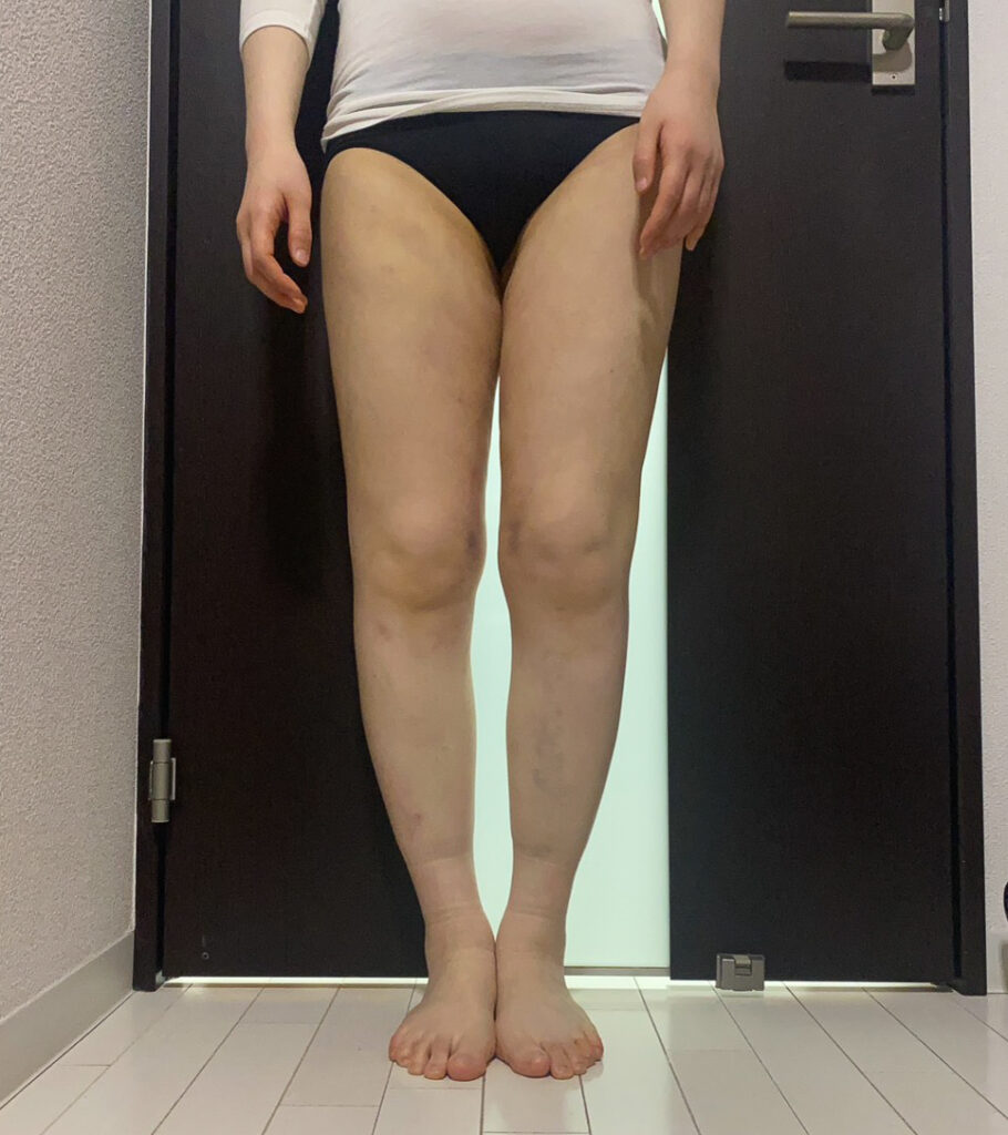 足の脂肪吸引