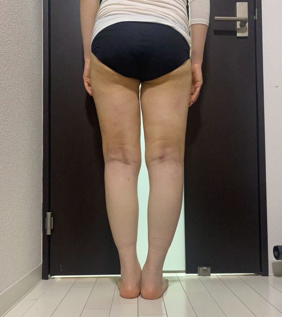 足の脂肪吸引