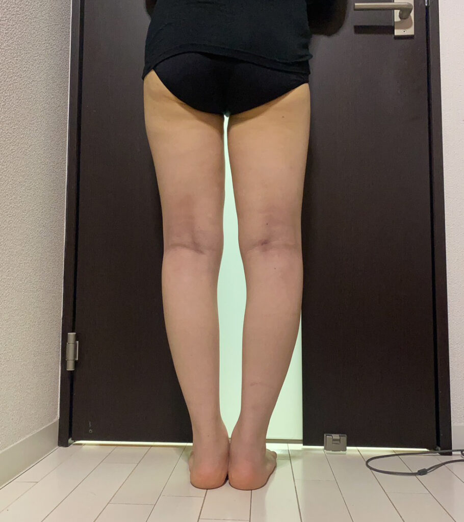 足の脂肪吸引