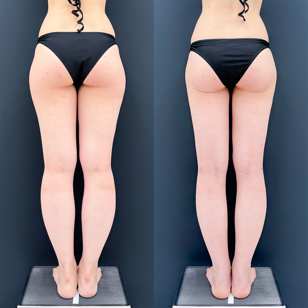 https://purelys-tokyo-clinic.com/wp/wp-content/uploads/2026/04/leg-Liposuction_Case-No.948.jpg