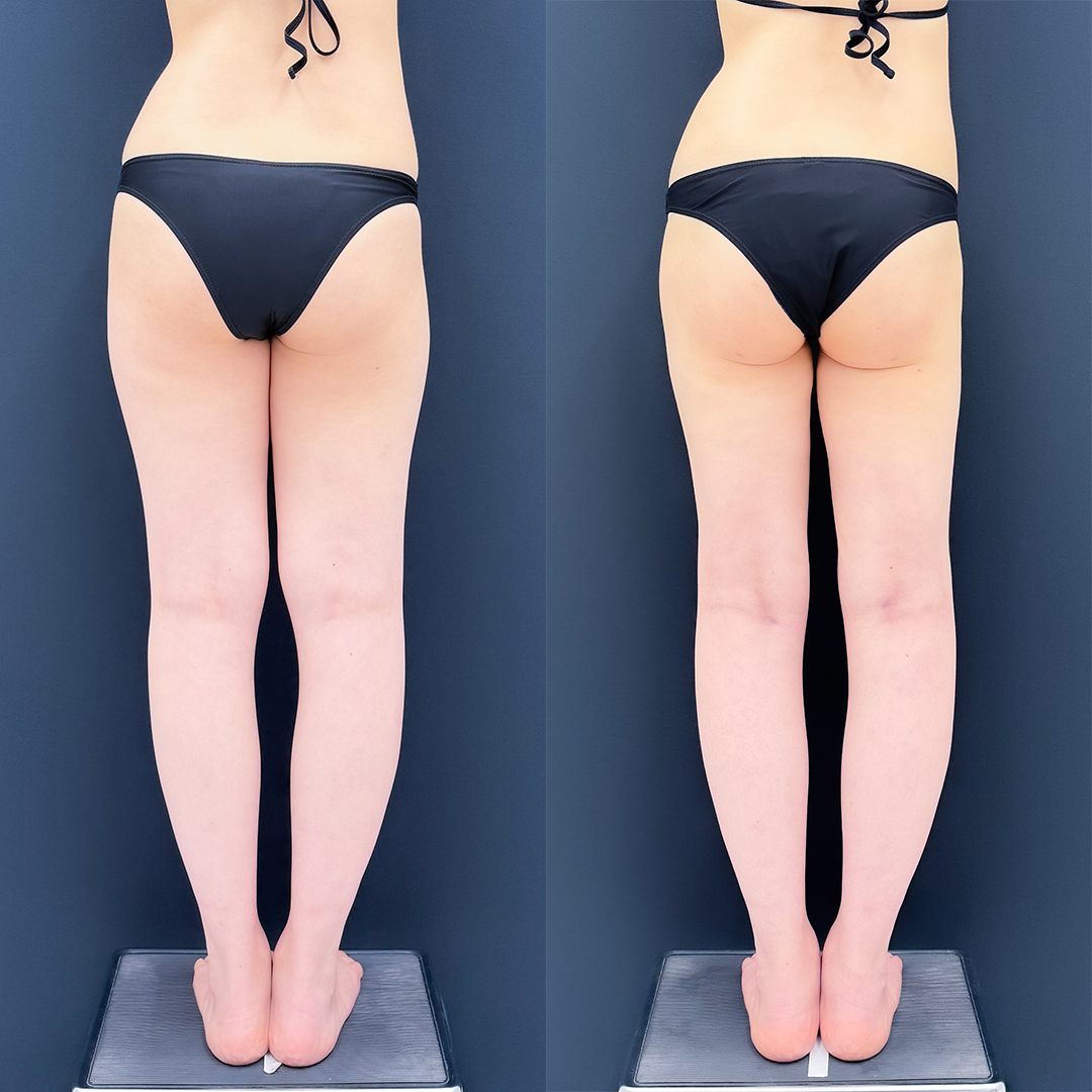 https://purelys-tokyo-clinic.com/wp/wp-content/uploads/2026/04/leg-Liposuction_Case-No.954.jpg