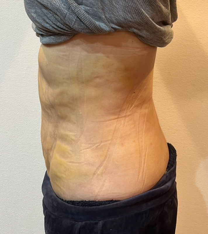 お腹の脂肪吸引