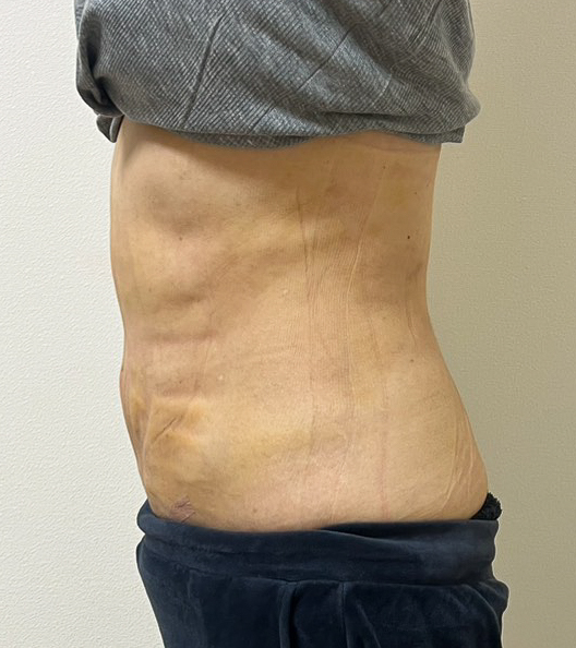 お腹の脂肪吸引